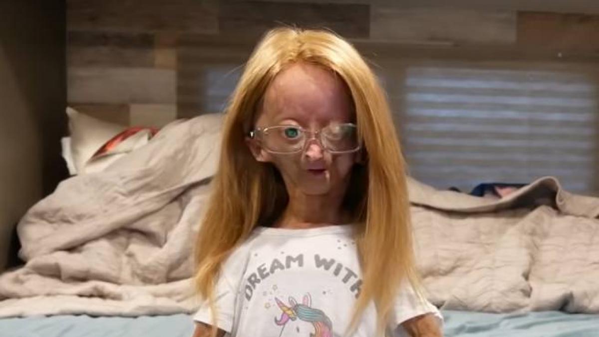 Muere Adalia Rose Youtuber Con El Síndrome De Progeria Blog Ortopedia Silvio